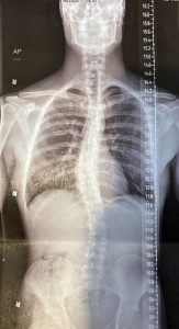 Understanding Scoliosis, from Childhood Curves to Adult Spine Pain